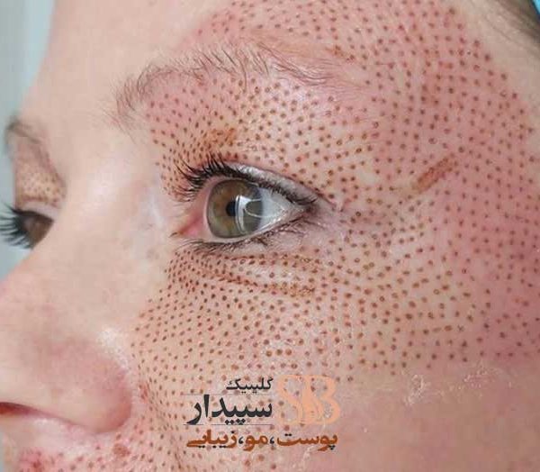 جوانسازی و لیفت صورت با پلاسما جت