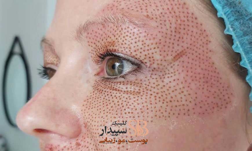 جوانسازی و لیفت صورت با پلاسما جت