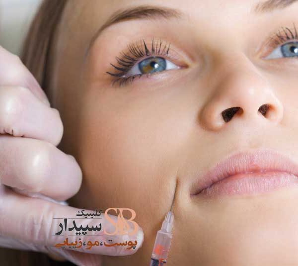 جوانسازی صورت و رفع خط خنده با بوتاکس