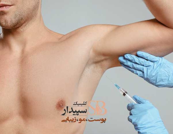 بوتاکس زیر بغل