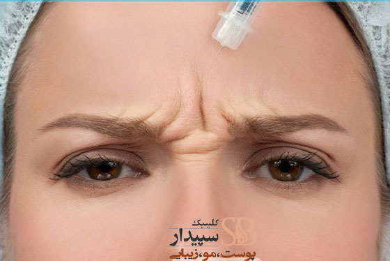 تزریق ژل خط اخم و چروک پیشانی