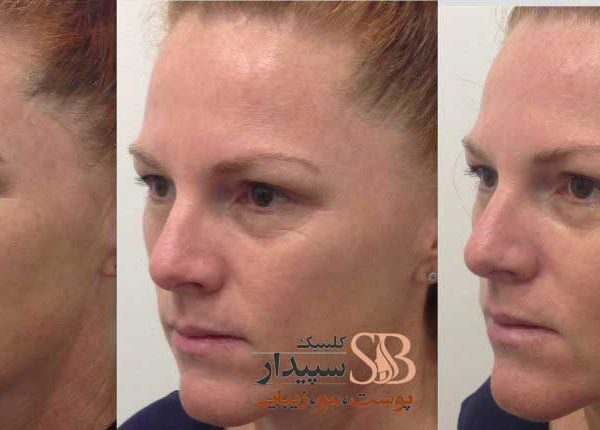 هایفو شرق تهران