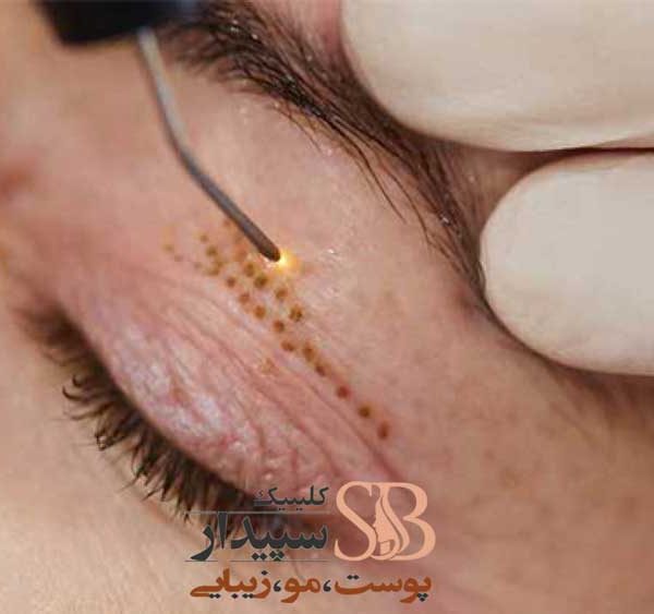 جوانسازی با پلاسما جت و مراقبت های بعد از آن