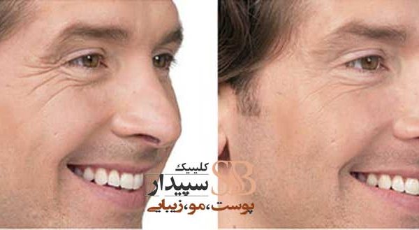 جوانسازی پوست