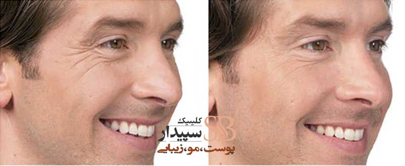 جوانسازی پوست