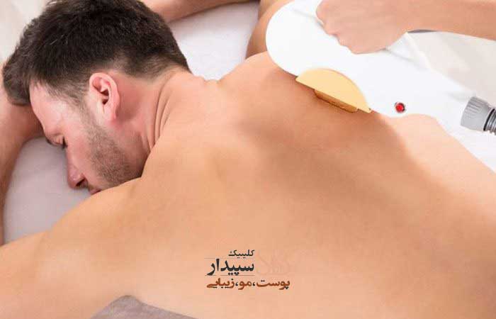 لیزر موهای زائد