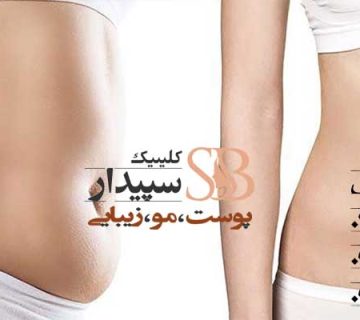 لاغری با دستگاه کویتیشن